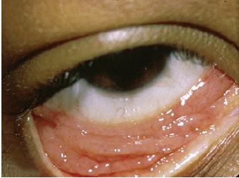 infection in the eyes